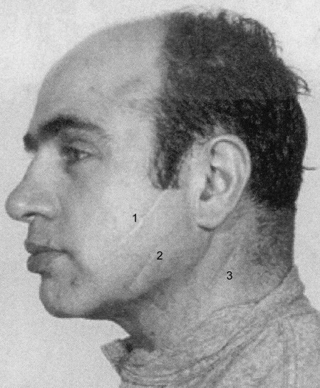 A rare photo of "Scarface" Al Capone that shows his scars. He went out of his way to avoid being photographed from this side in order to hide them